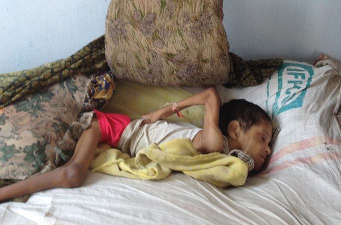 Fluorosis can severely cripple individuals, and make some appear as a 'living corpse' [M.A.R. Fareed]