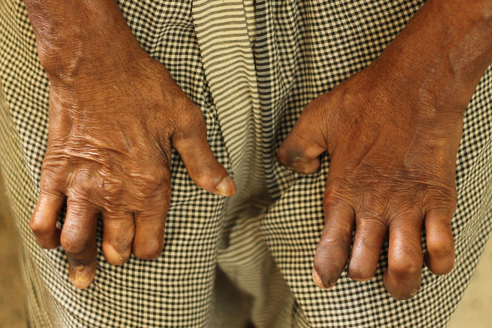 LEPROSY, Nepal/ Please Do Not Use