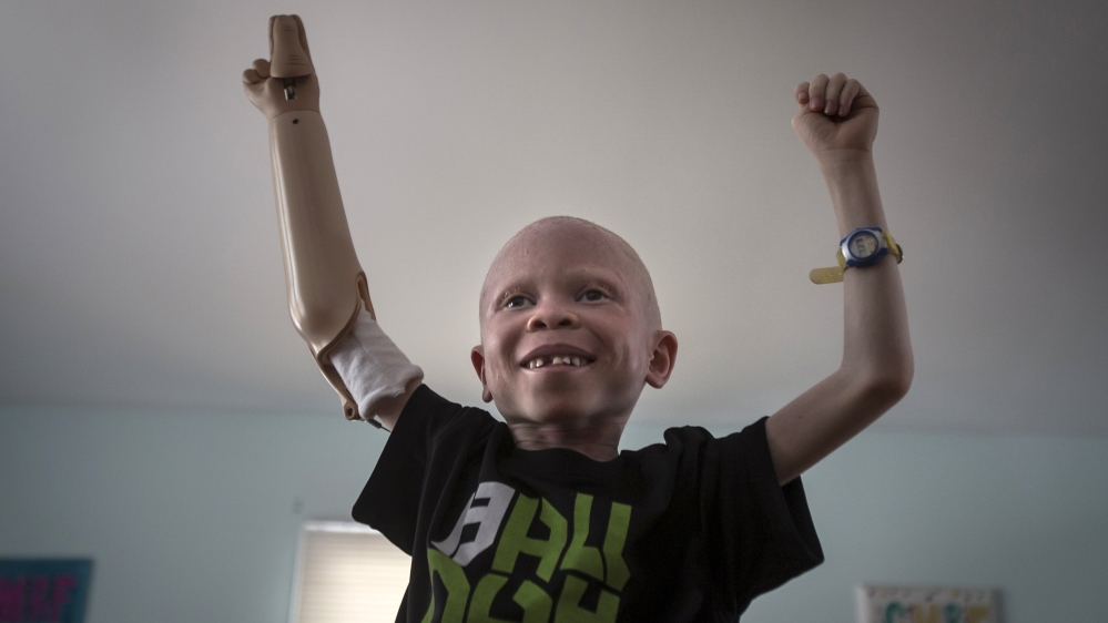 Albinism is a congenital disorder affecting about one in 20,000 people worldwide [Reuters]