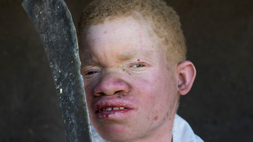 Malawi albinism survivor