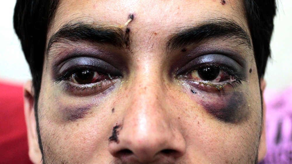  Muhammad Ashraf, 19, from Budgam, told Al Jazeera that he was walking through paddy fields on September 14 when armed forces fired pellets at him from the highway. He says there were no protests at the time, and he was shocked when he was hit. On the way to the hospital, he says he was stopped at a checkpoint and beaten by police. He says he has taken part in protests and his village has seen many clashes between police and protests [Shuaib Masoodi/Al Jazeera]