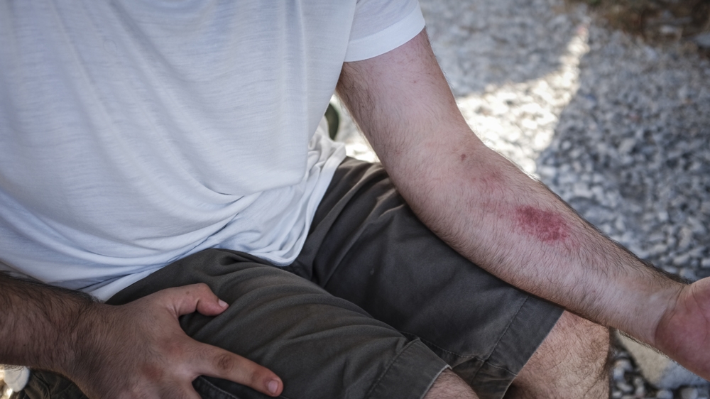 Rami Alqdman, 28, shows the red markings on his arms from holding on to a life jacket and Walat Abdi for seven hours. He also suffered muscle cramps and dehydration from the ordeal. 'The experience [in Syria] I cannot compare with what happened to us in the sea. Trust me, it was horrifying in the middle of the sea. It was very dark and everyone was screaming. Some people who were screaming just disappeared. I kept hearing the voices become fewer and fewer until finally there were no voices. I understood that maybe everyone died' [Fahrinisa Oswald/Al Jazeera]