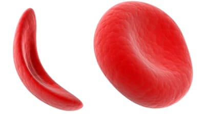 Sickle shapped red blood cells [Photo courtesy: Sickle Cell Institute, Raipur]