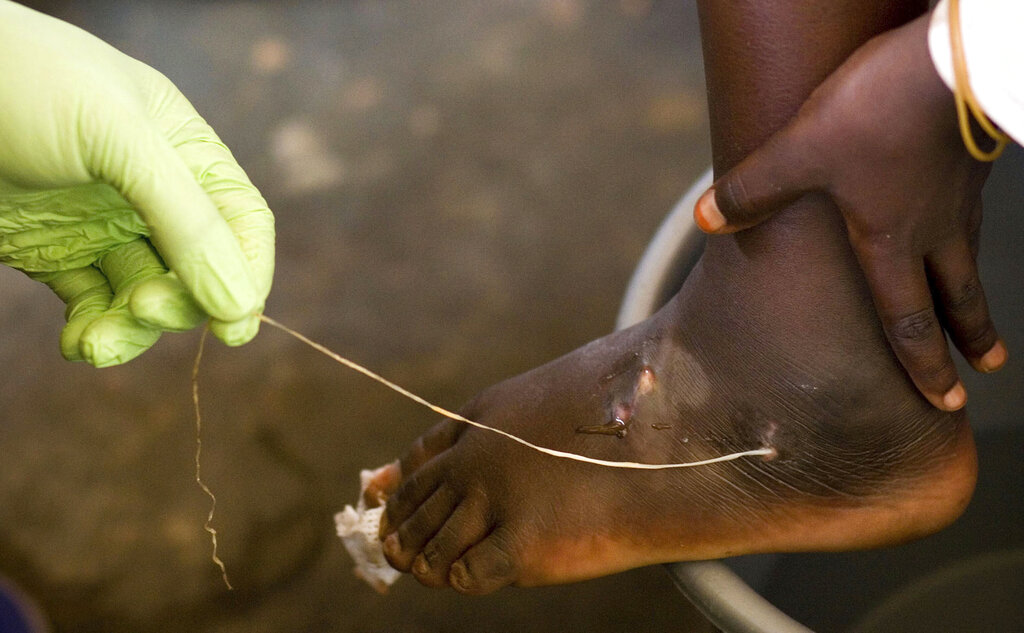 In this 2007 file photo, a Guinea worm is extracted by a health worker from a child's foot at a containment center in Ghana.