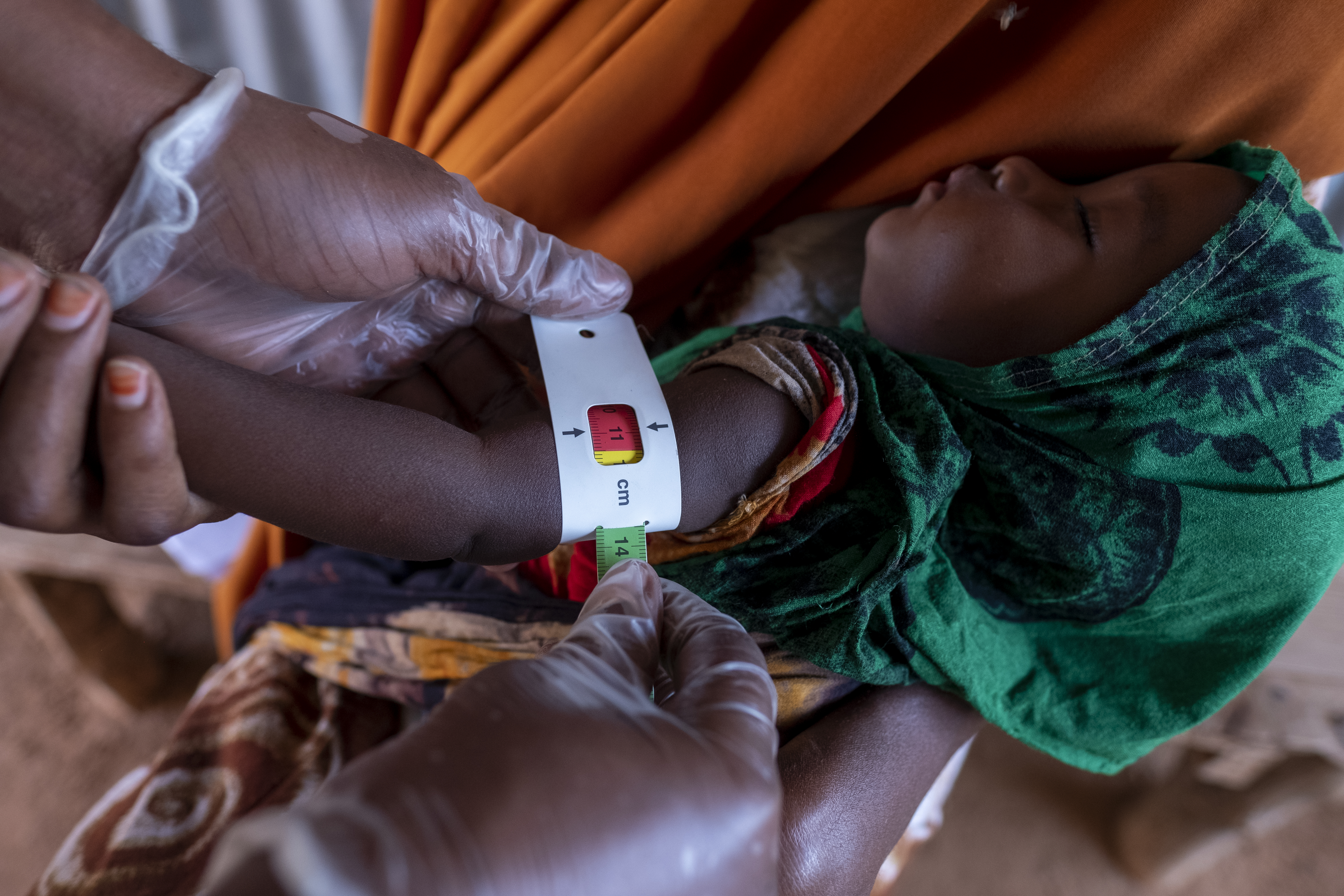 A child, 7 month old Fardowsa Adan Mohamed being examined in a unicef funded clinic to find the extemt of malnutrion due to the severe drought in the region.