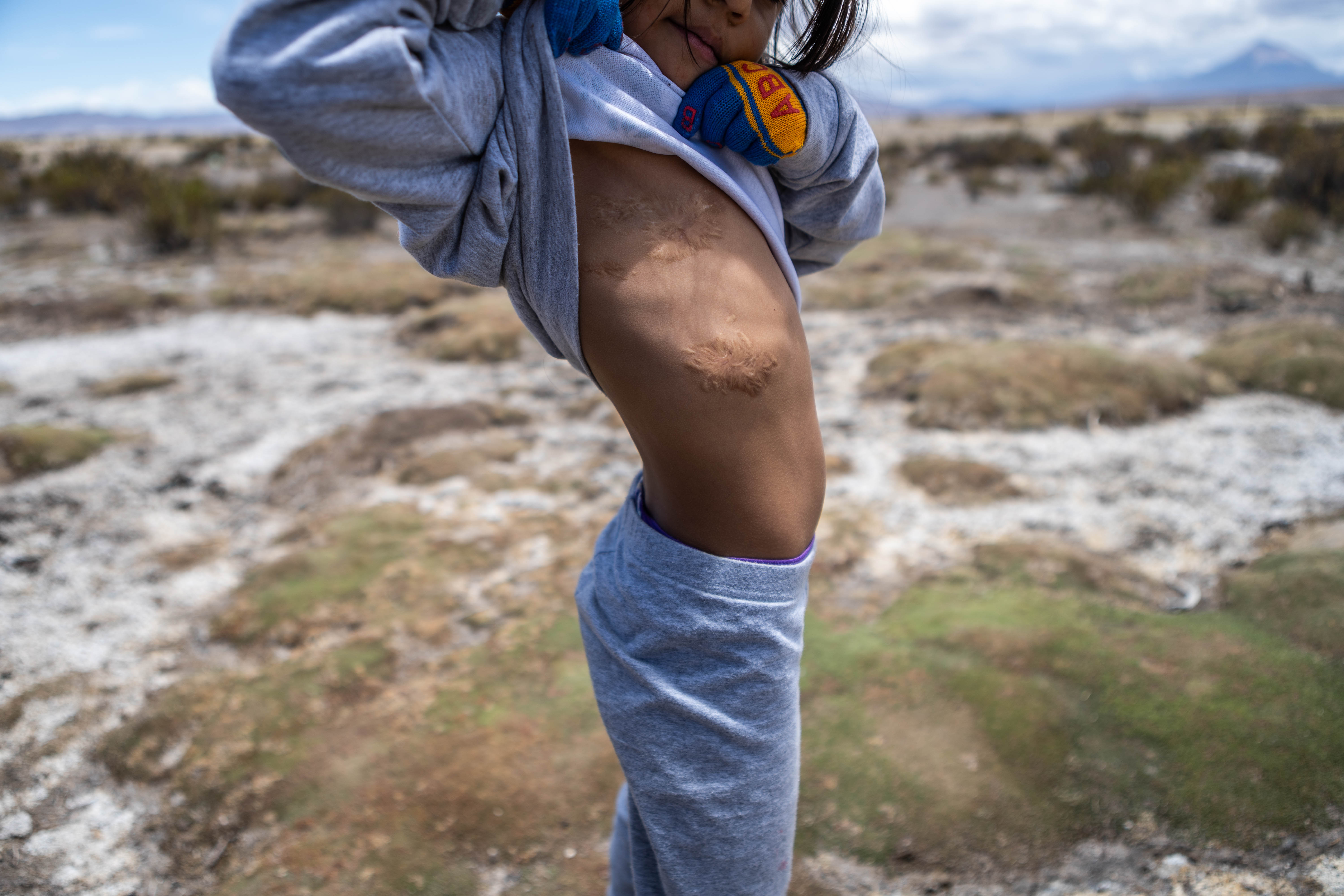 A young girl lifts her grey sweatshirt to reveal knots of scar tissue where her lung surgery took place.