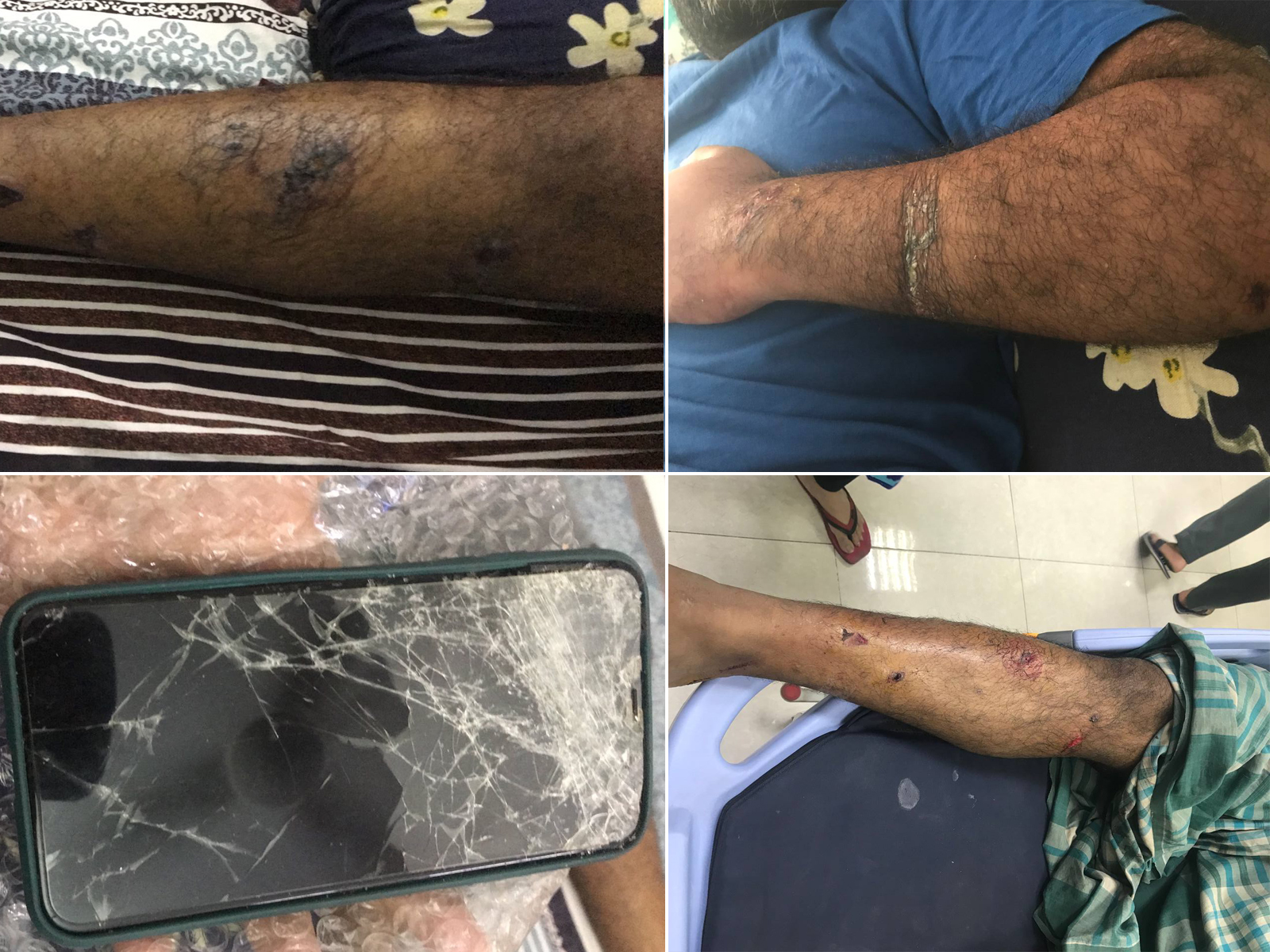 A collage of four pictures showing bruises and a broken phone