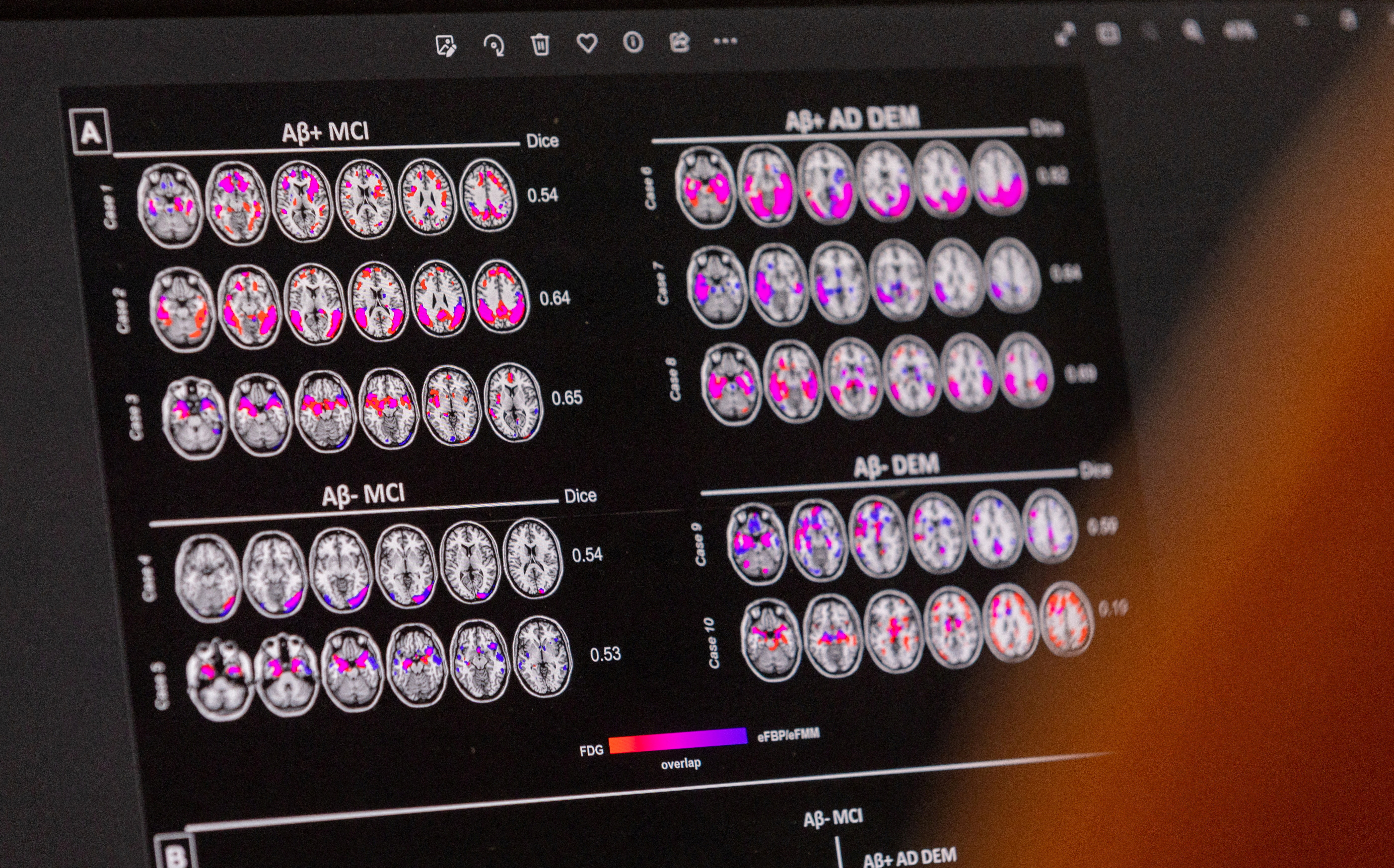 A scientist looks at hypometabolic and hypoperfusion patterns at the single-subject level from a patient suffering from Alzheimer's disease