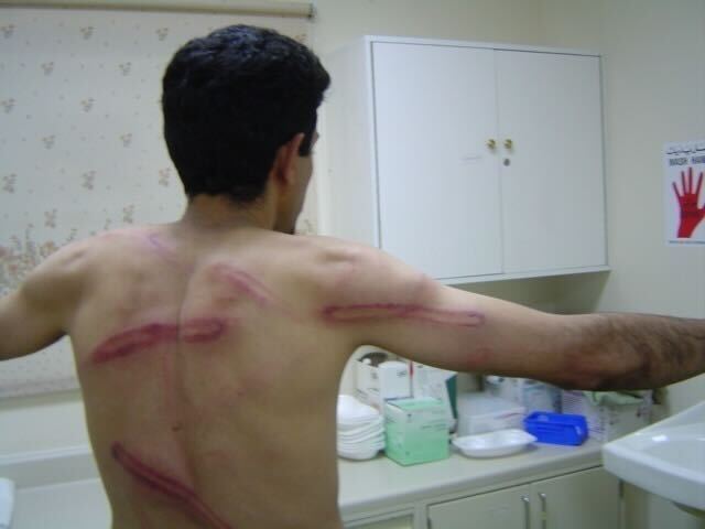The injuries sustained by Abdulhadi al-Khawaja while imprisoned