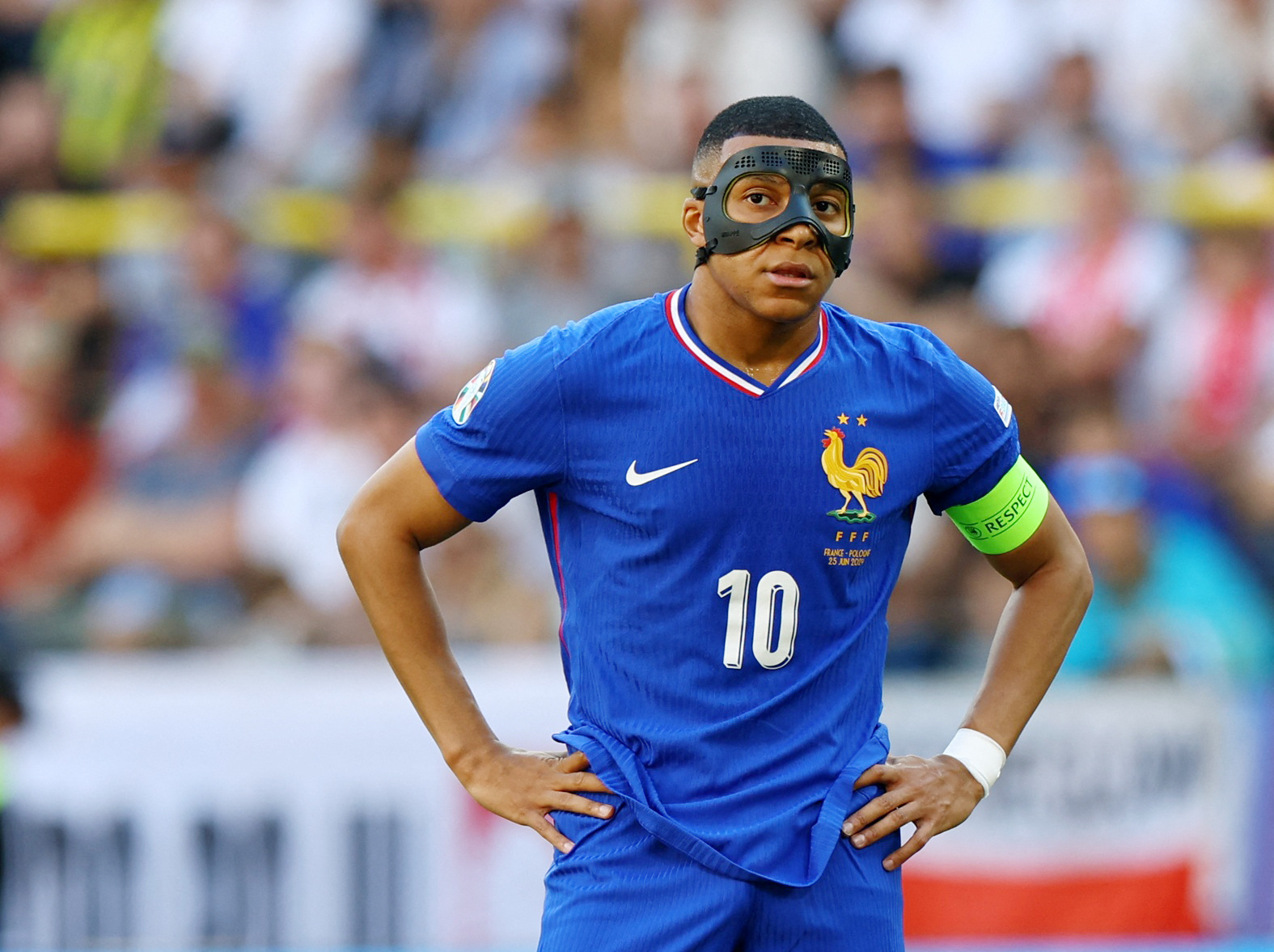 Mbappe suffered a broken nose in his first Euro 2024 match against Austria, affecting his performance throughout the tournament