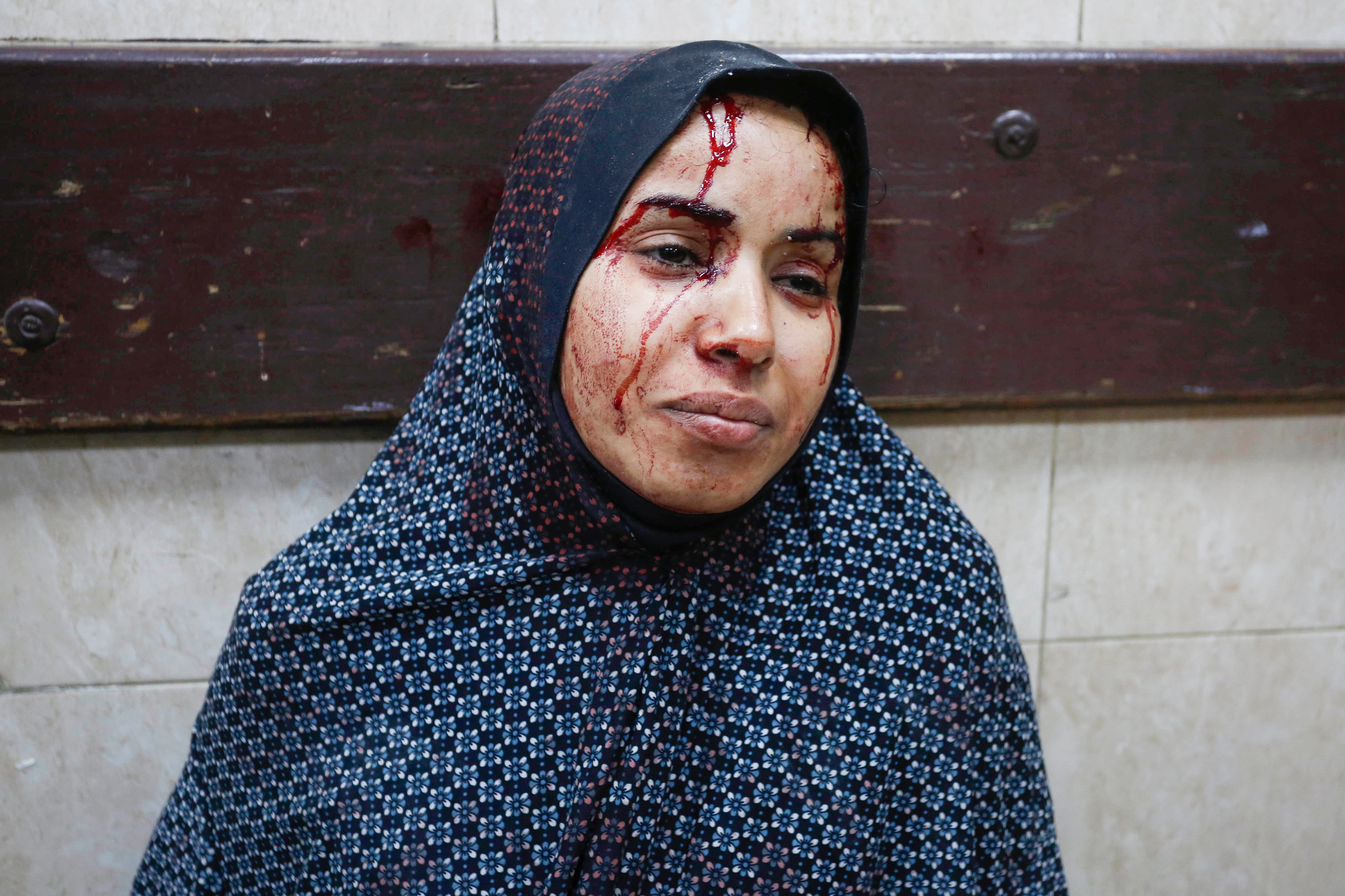 A woman injured in an Israeli airstrike on a school