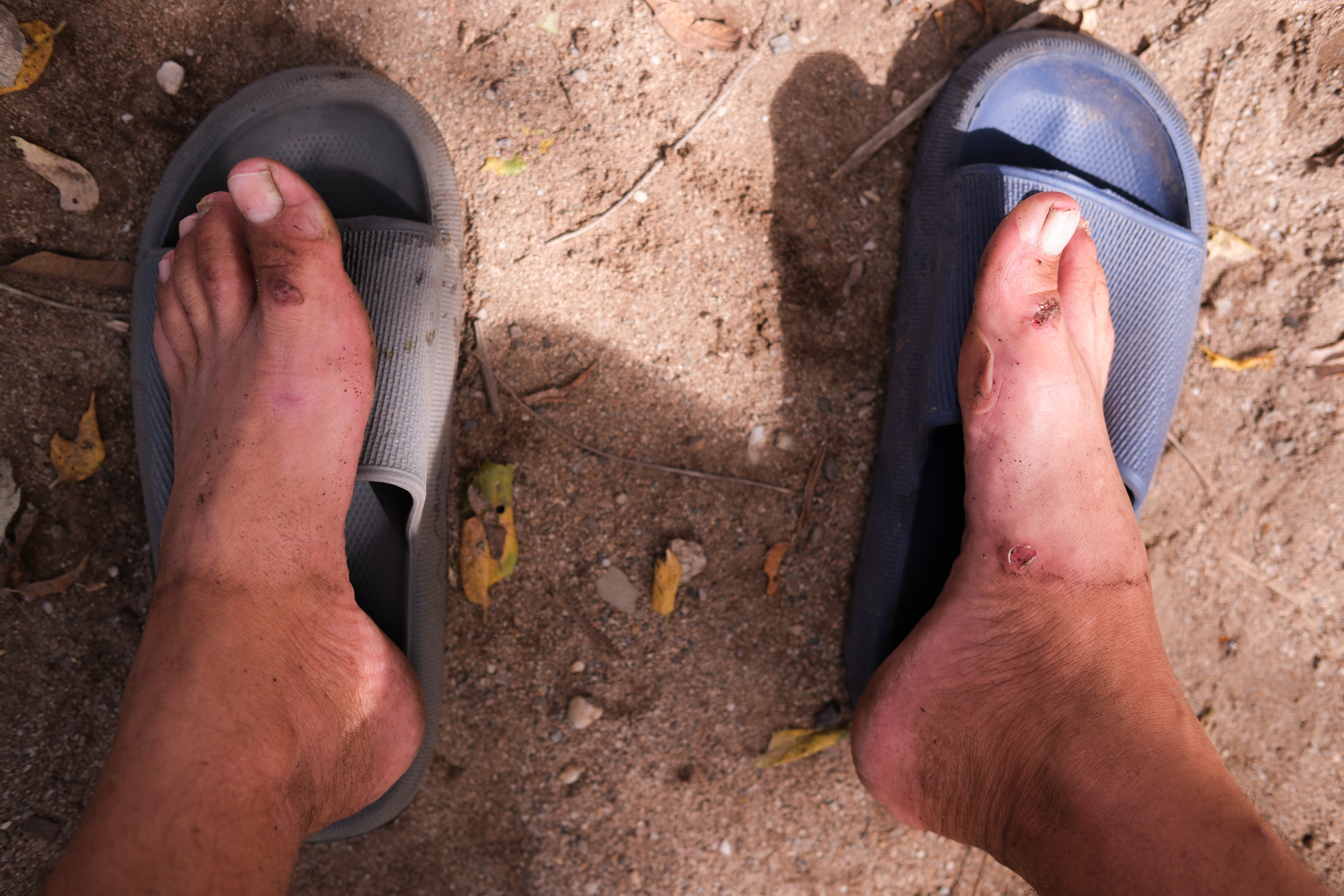 Omar Ramirez's blistered feet