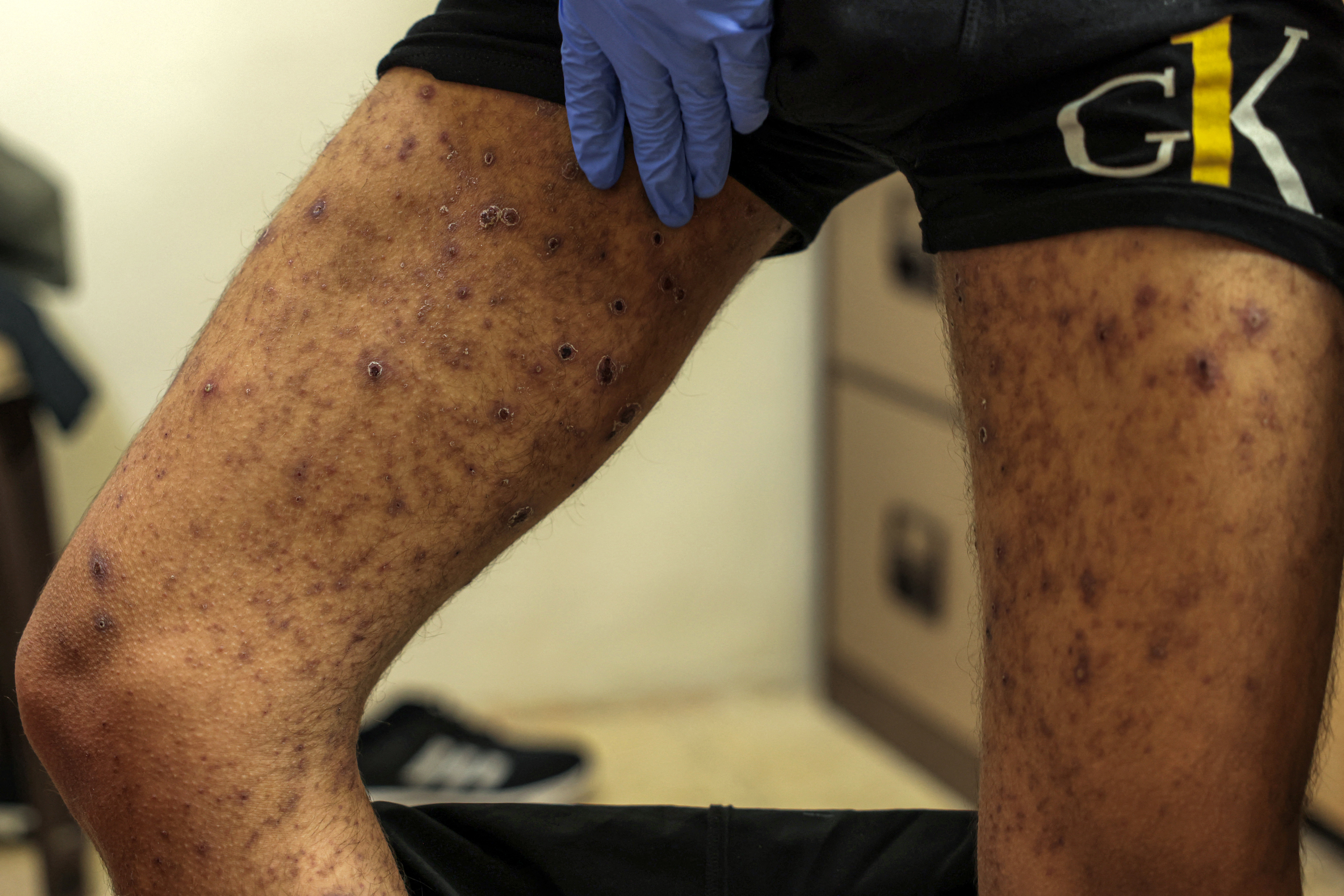 Rida Obeid, an 18-year-old Palestinian suffering from scabies, shows the infection on his harm.