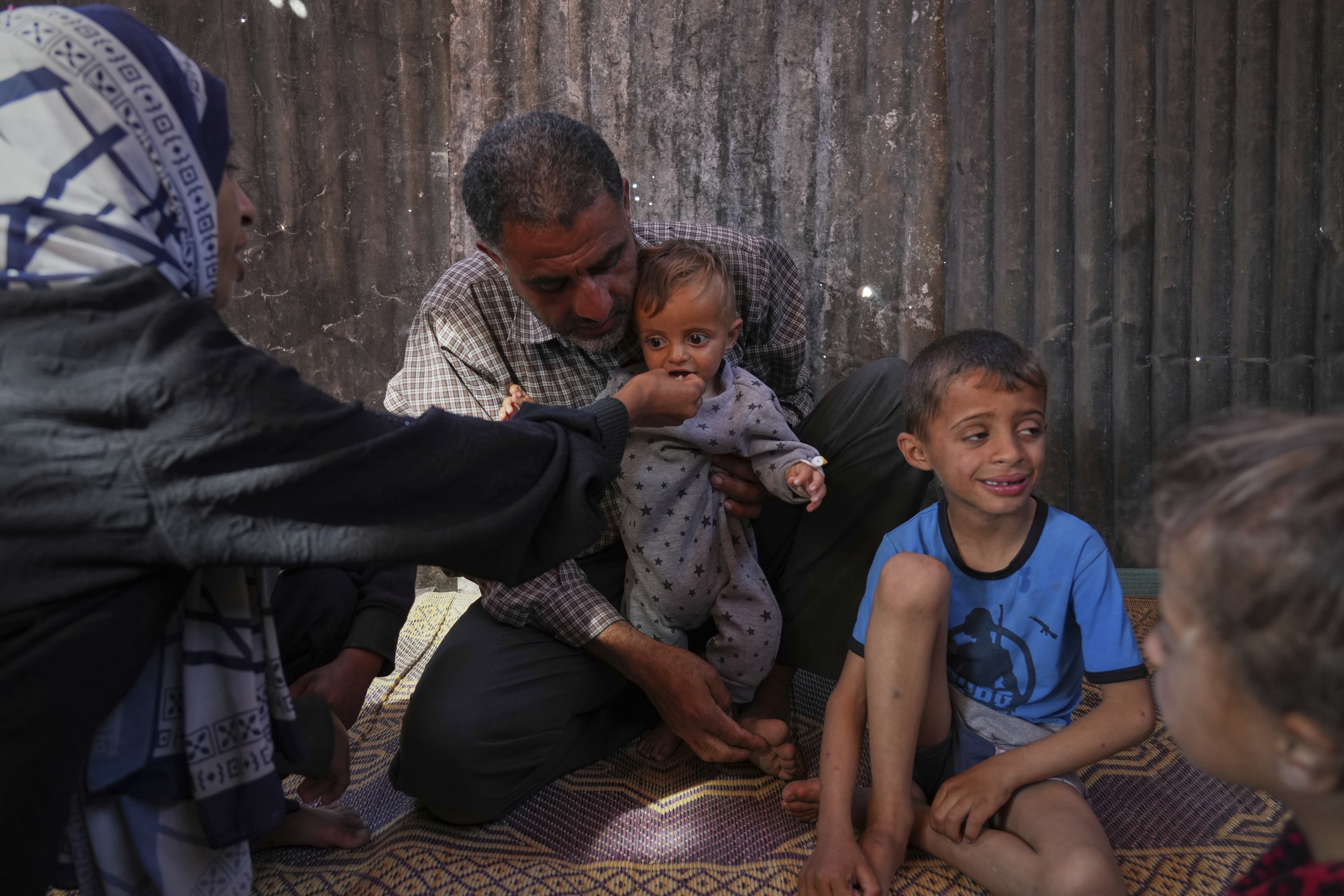 Mideast Wars Malnourished Children
