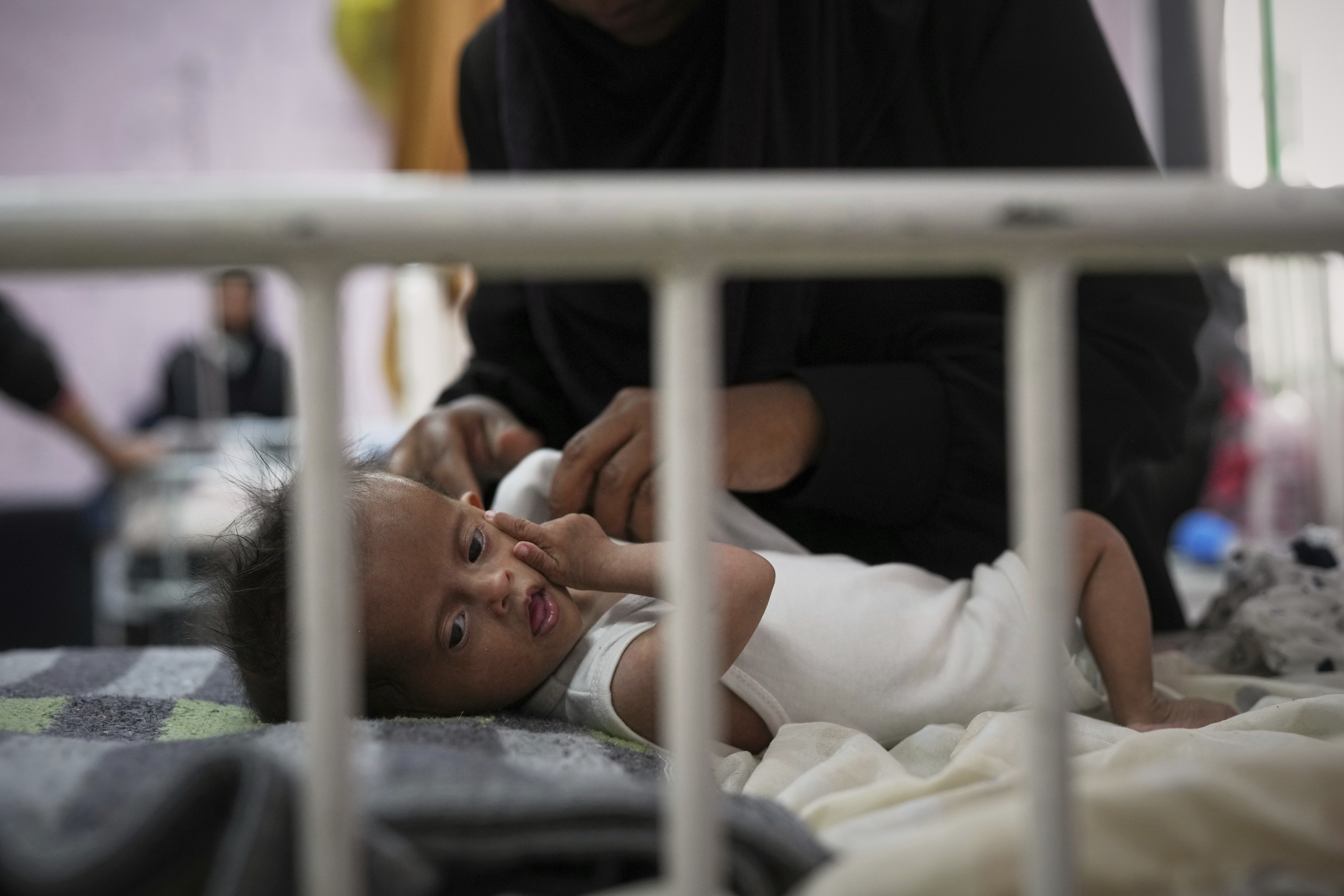 Mideast Wars Malnourished Children