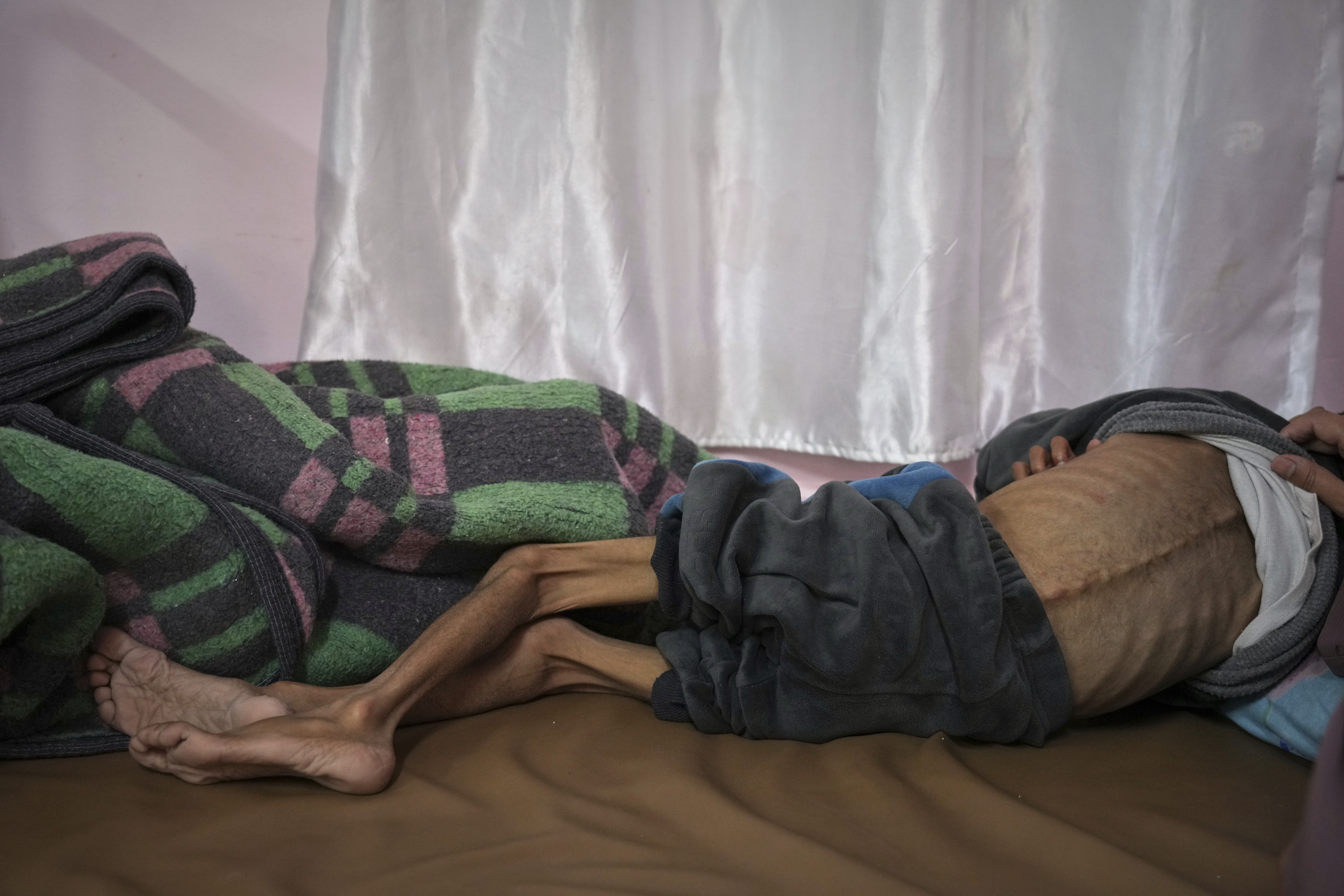 Mideast Wars Malnourished Children