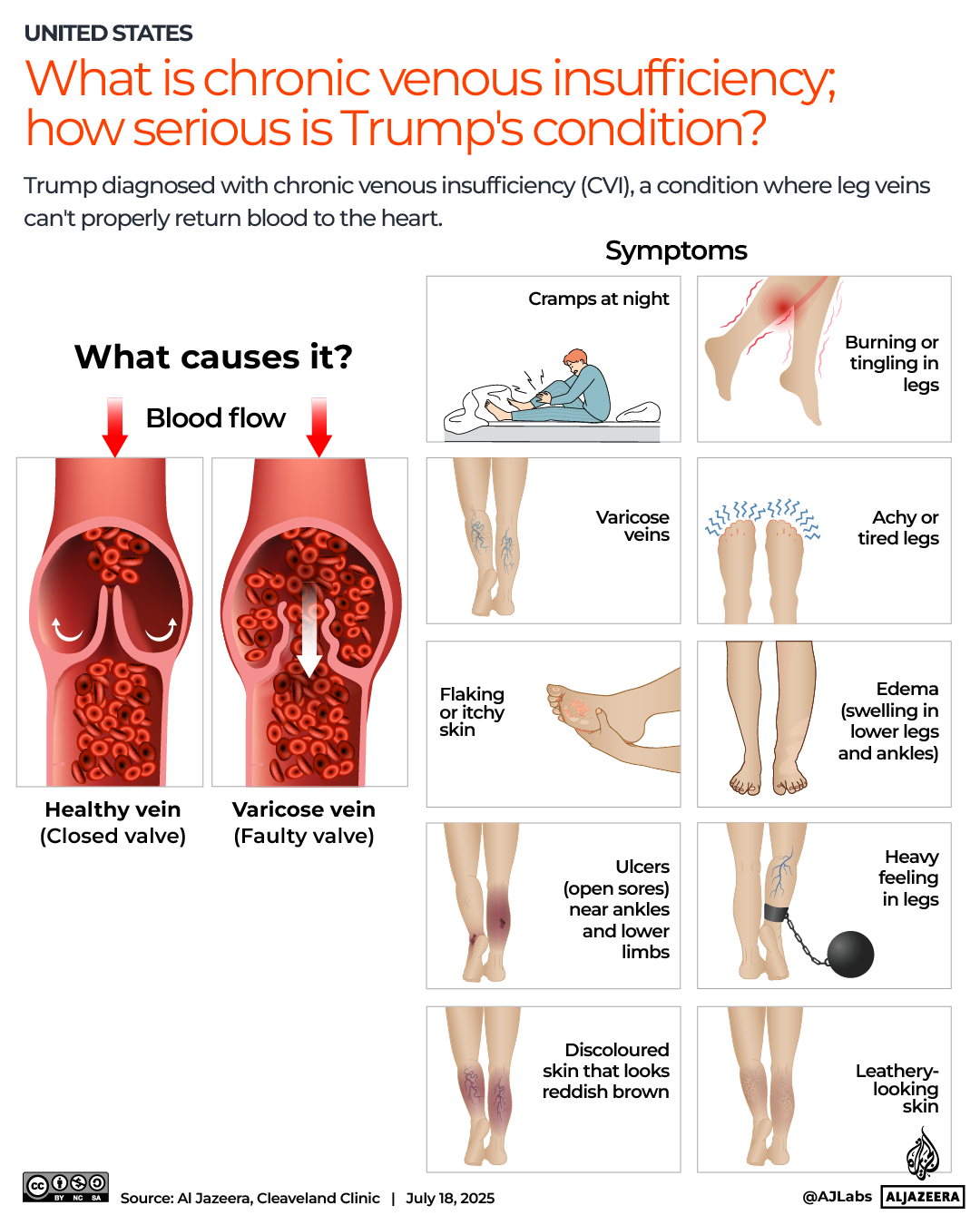 Interactive_Chronic_Venous_Insufficiency_Vein_Trump-July18_2024