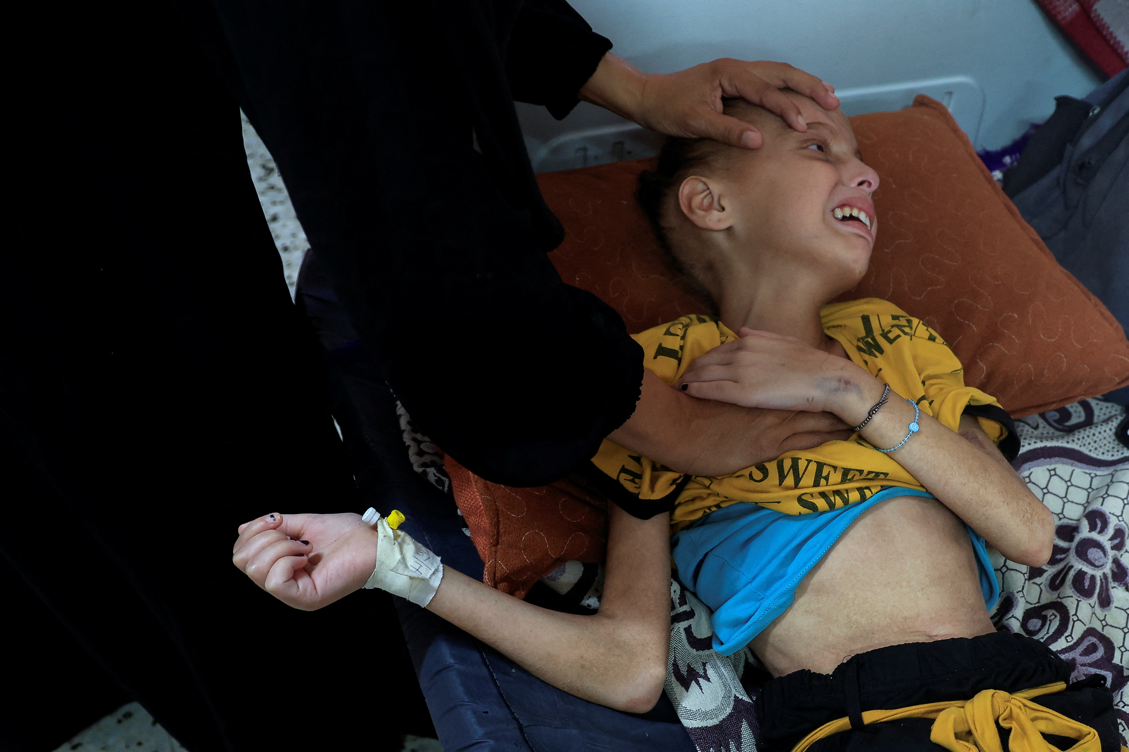 Huda Abu Naja lies on a bed as she receives treatment at the malnutrition ward at Nasser hospital in Khan Younis, southern Gaza Strip