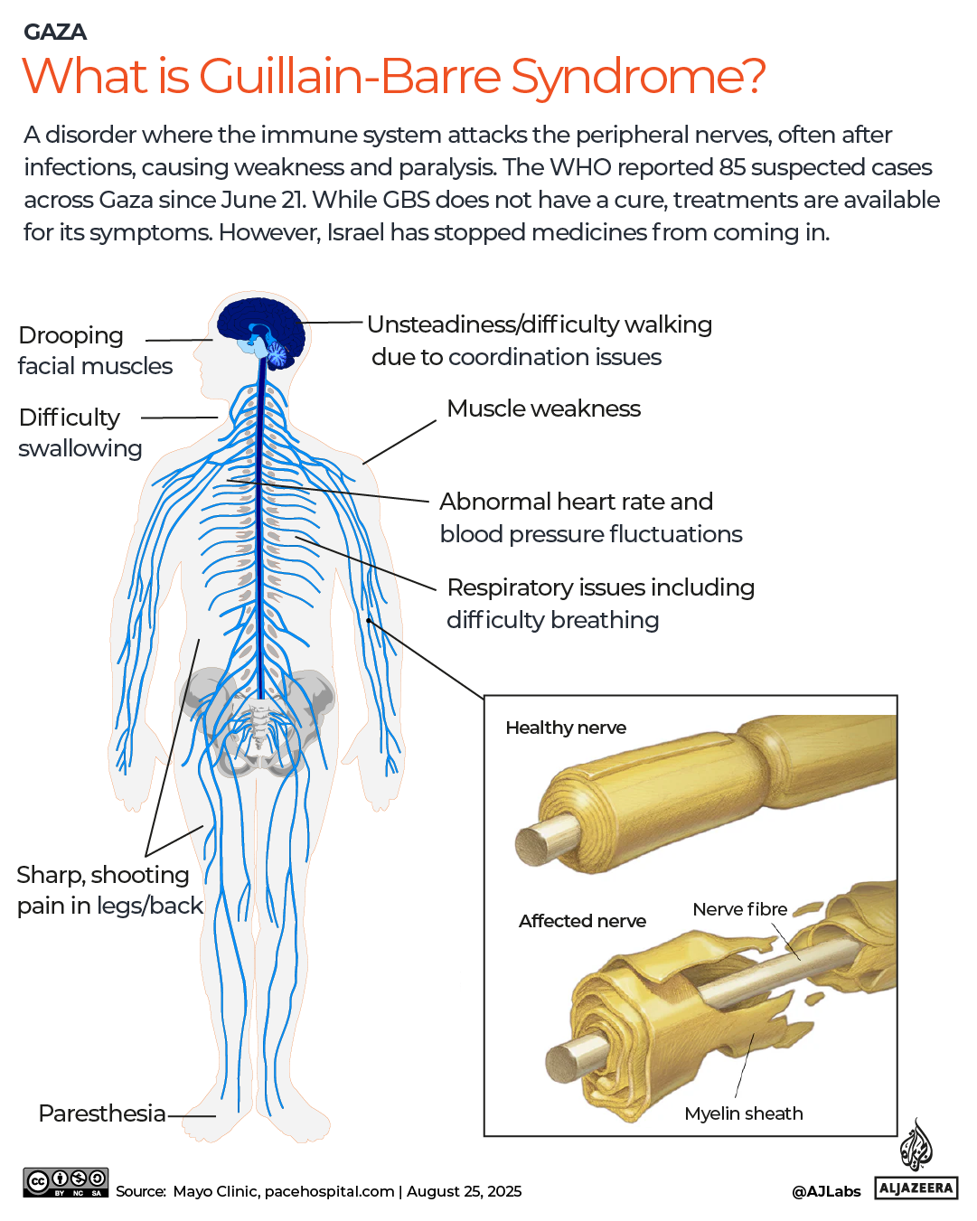 INTERACTIVE-What is GBS?