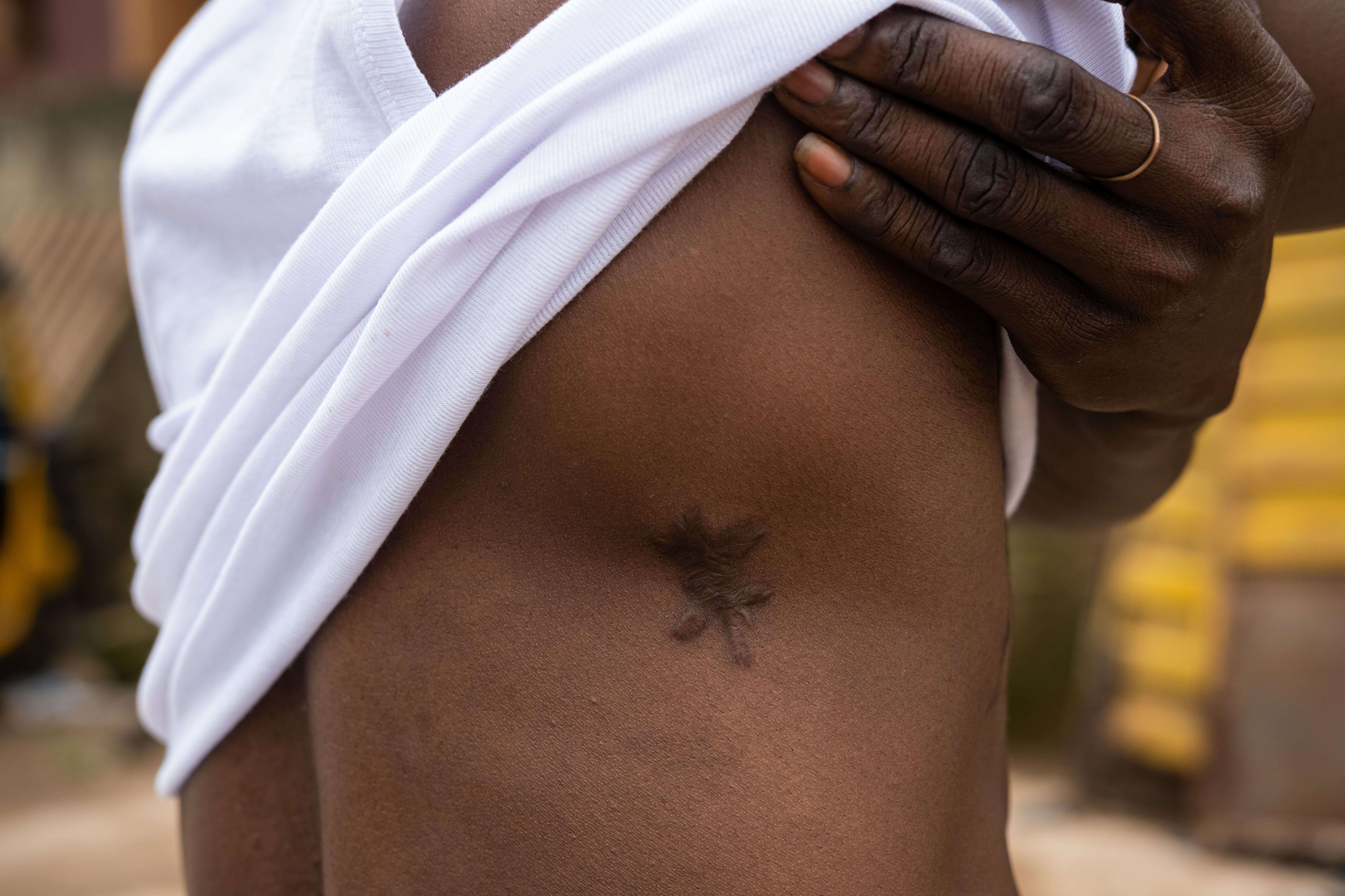 Agbeze Matthew shows the wound where the bullet entered his body [Pelumi Salako/Al Jazeera]