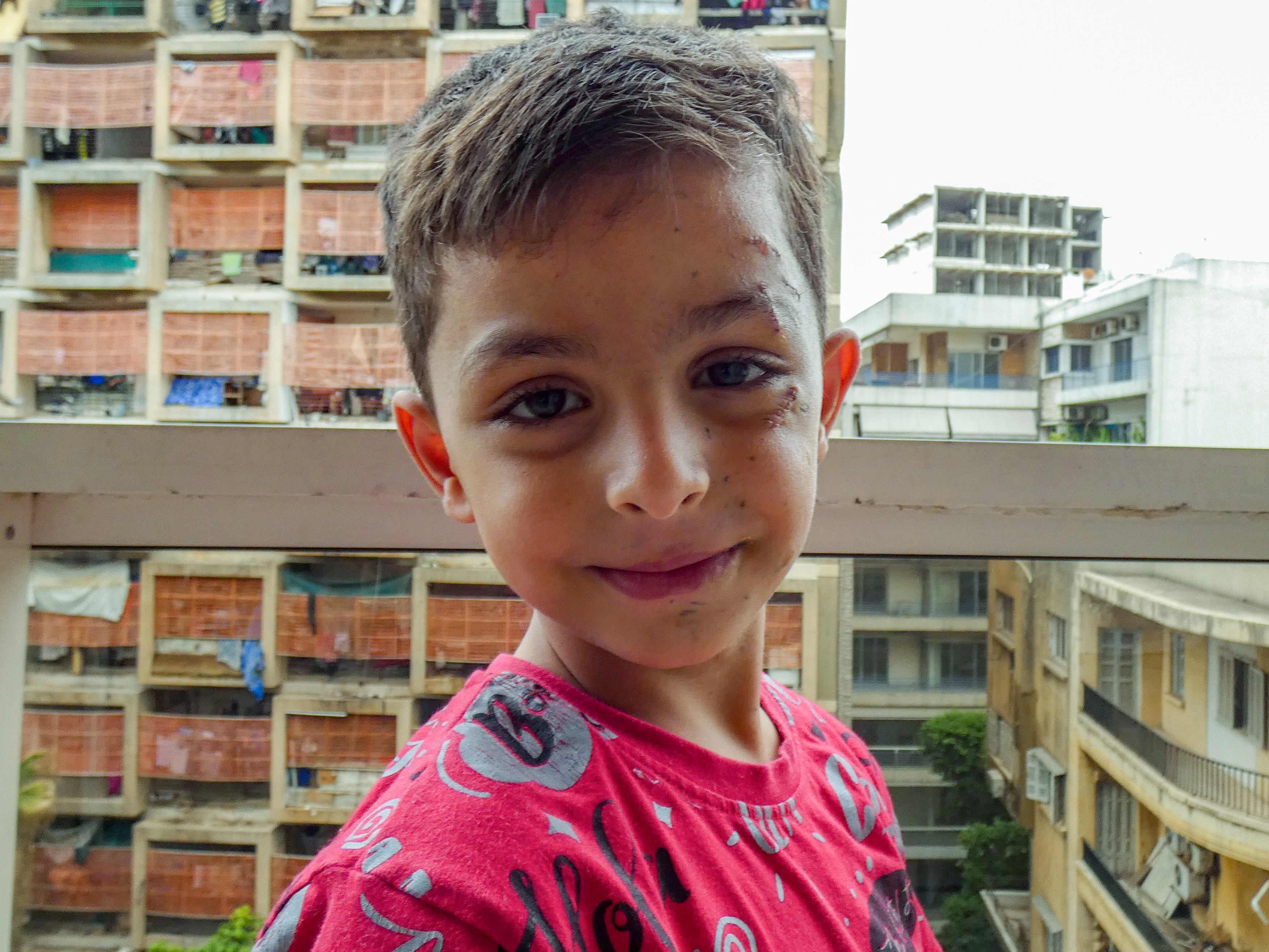 A closeup of Omar's face, where the extensive scarring to the left side of his face is visible. He still smiles at the camera, the scars on the left puckering around his large eyes