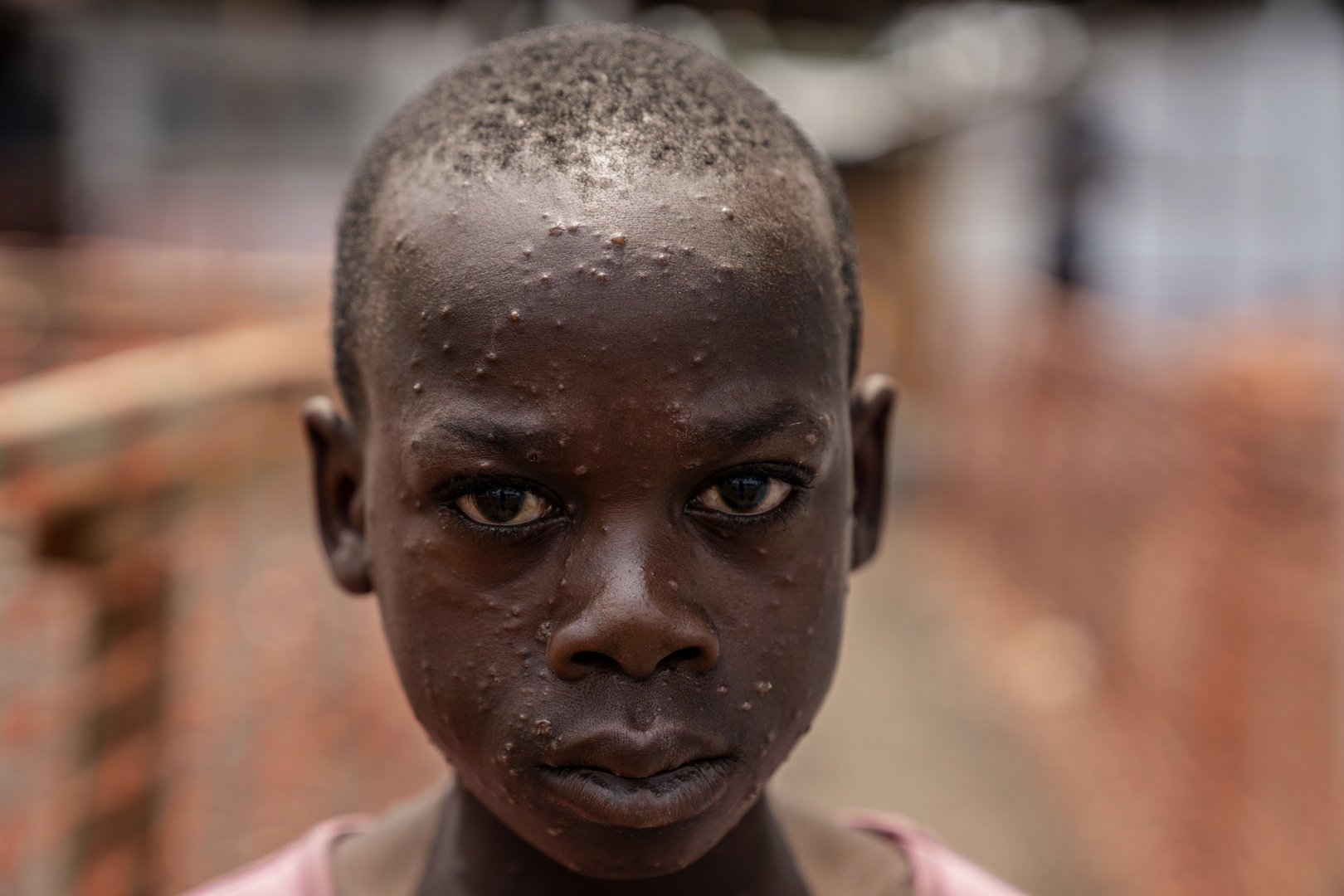 A girl suffering from mpox waits for treatment at a clinic in Munigi, eastern Congo on Aug. 19, 2024. [Moses Sawasawa/AP]