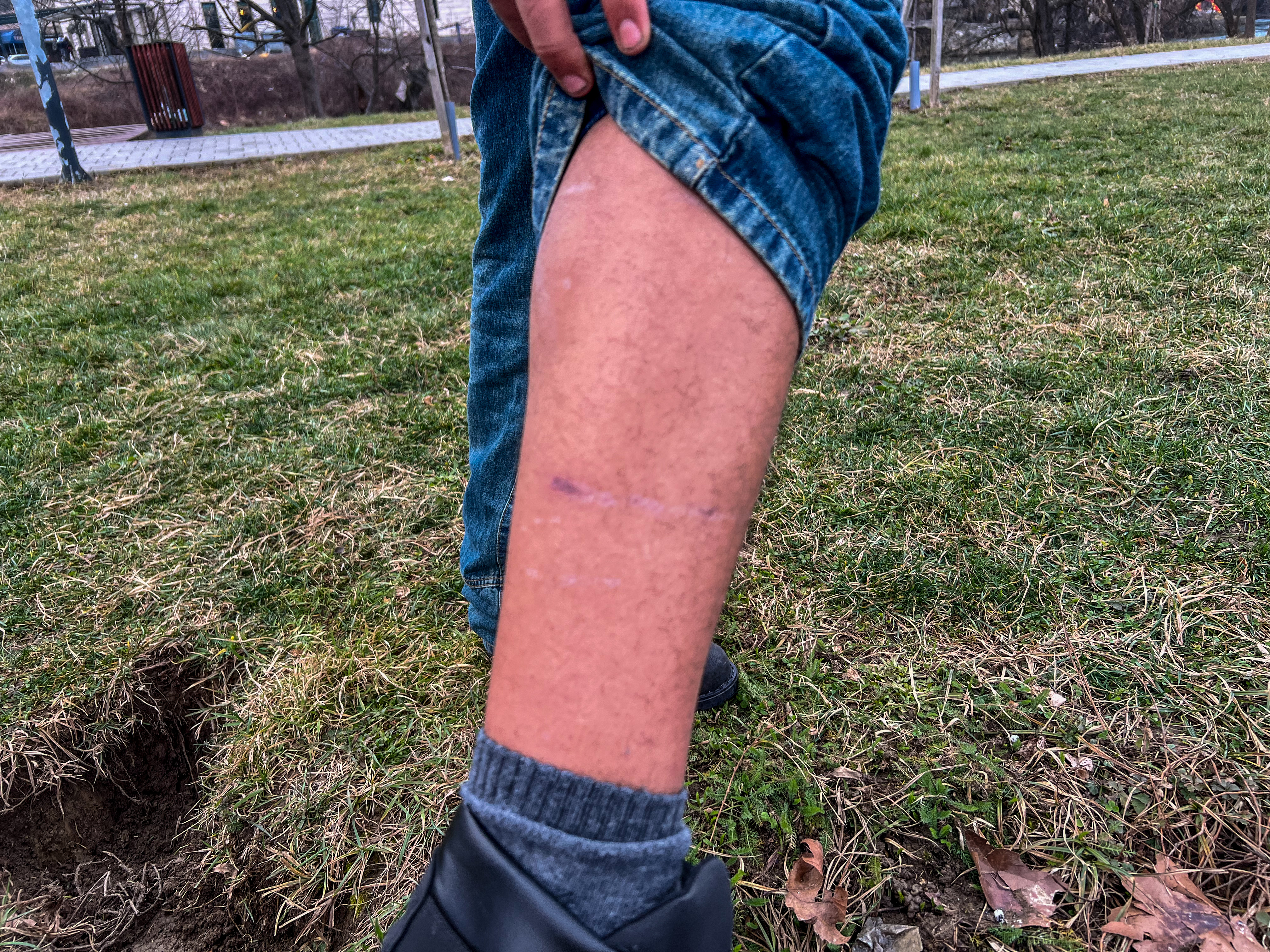 A teenager from the Atlas Mountains in Morocco shows his scars from wher EU border guards released attack dogs on him-1775035239