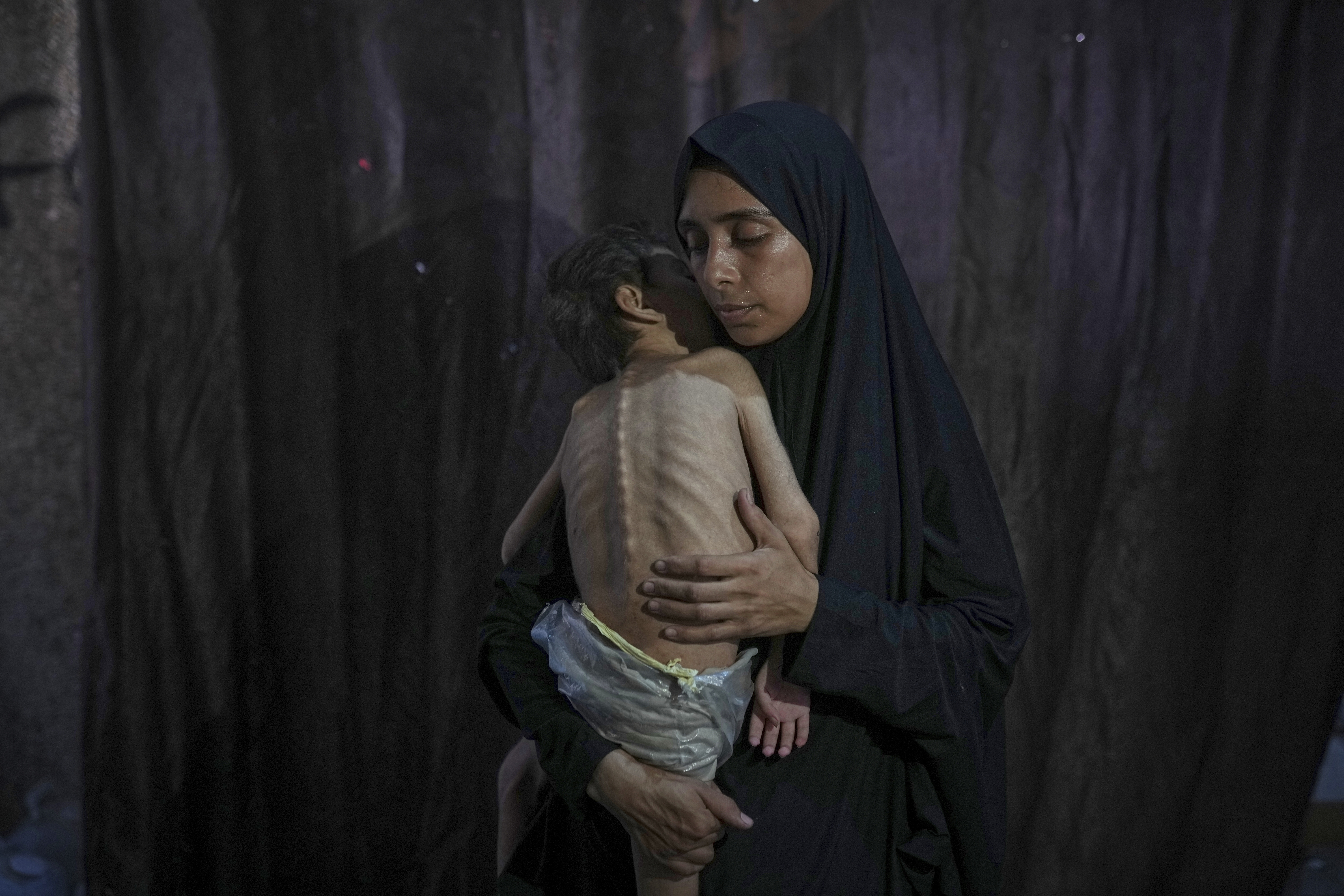 Samah Matar poses for a photo with her son Yousef, 6, who suffers from malnutrition and cerebral palsy, at a U.N.-run school in Gaza City, Saturday, July 26, 2025.
