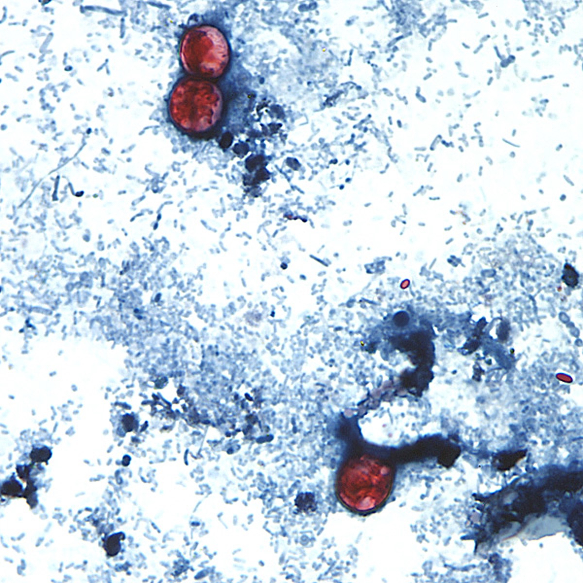 Undated microscope image provided by the US Centers for Disease Control and Prevention (CDC) showing cyclospora cayetanensis oocysts in a stool sample prepared with formalin and stained with safranin [CDC via AP]