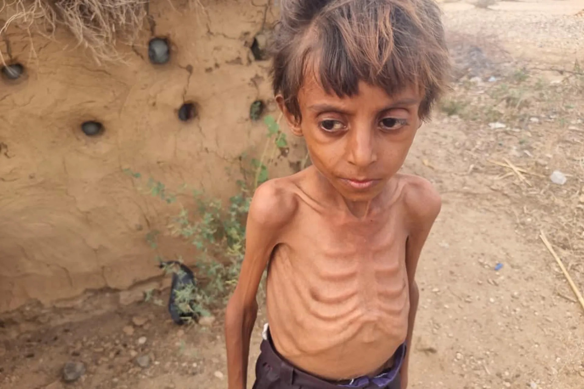 Hassan Razem, suffering from malnutrition, in Hajjah governorate of northern Yemen [Al Jazeera]